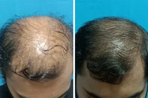 Hair rejuvation therapy before photo in VCare